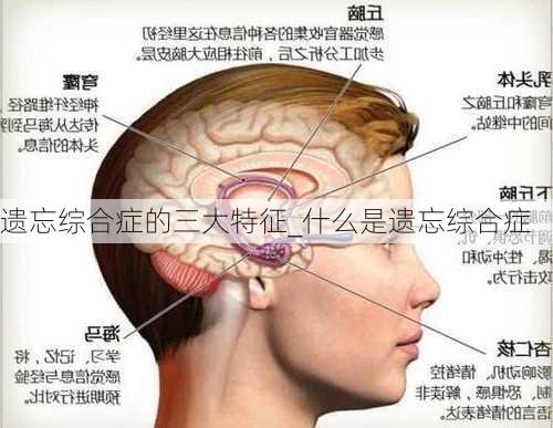 遗忘综合症的三大特征_什么是遗忘综合症