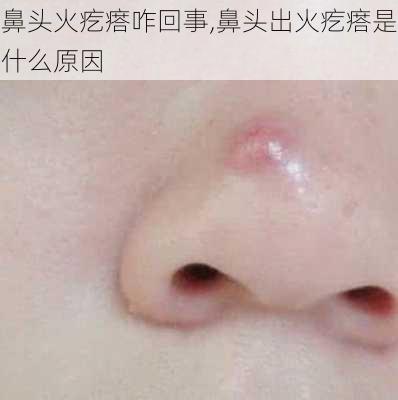 鼻头火疙瘩咋回事,鼻头出火疙瘩是什么原因