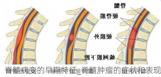 脊髓病变的早期特征_脊髓肿瘤的症状和表现