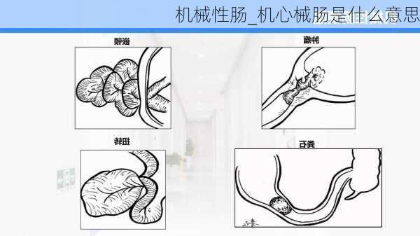 机械性肠_机心械肠是什么意思